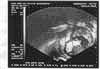 1. ultrazvuk 28.11.2002 - 12. tden